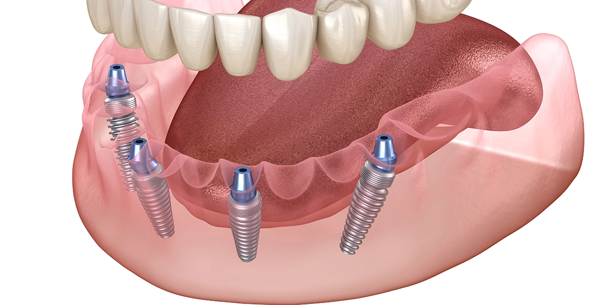 オールオン4とは