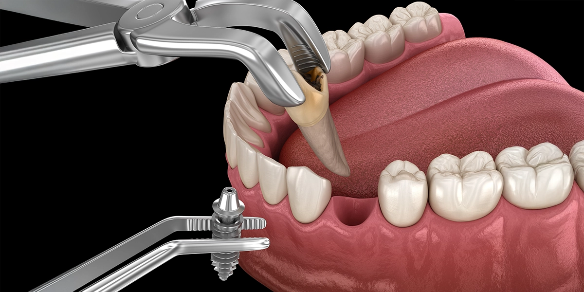 1dayインプラントとは